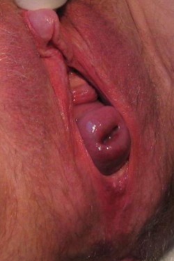 Fucking Her Prolapsed Cervix
