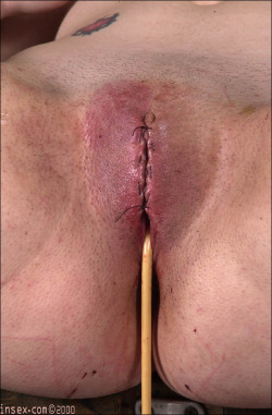 250px x 381px - Catheter Pussy Bdsm | BDSM Fetish